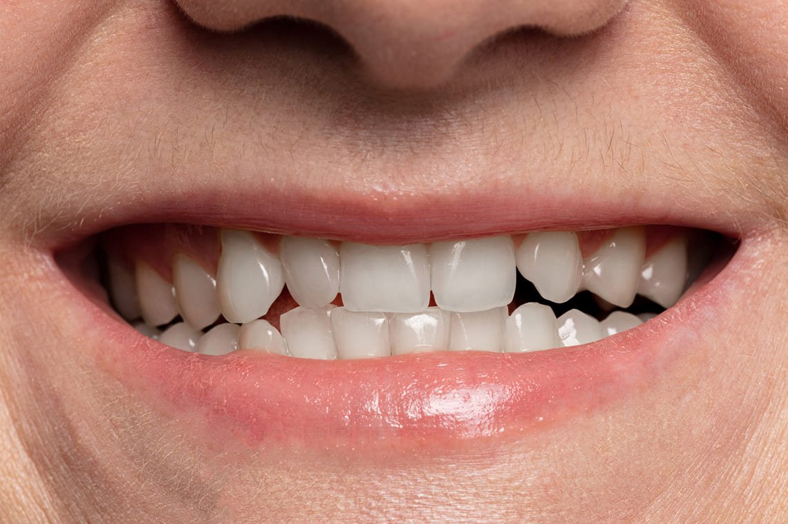 teeth-whitening-after-close-up.jpg