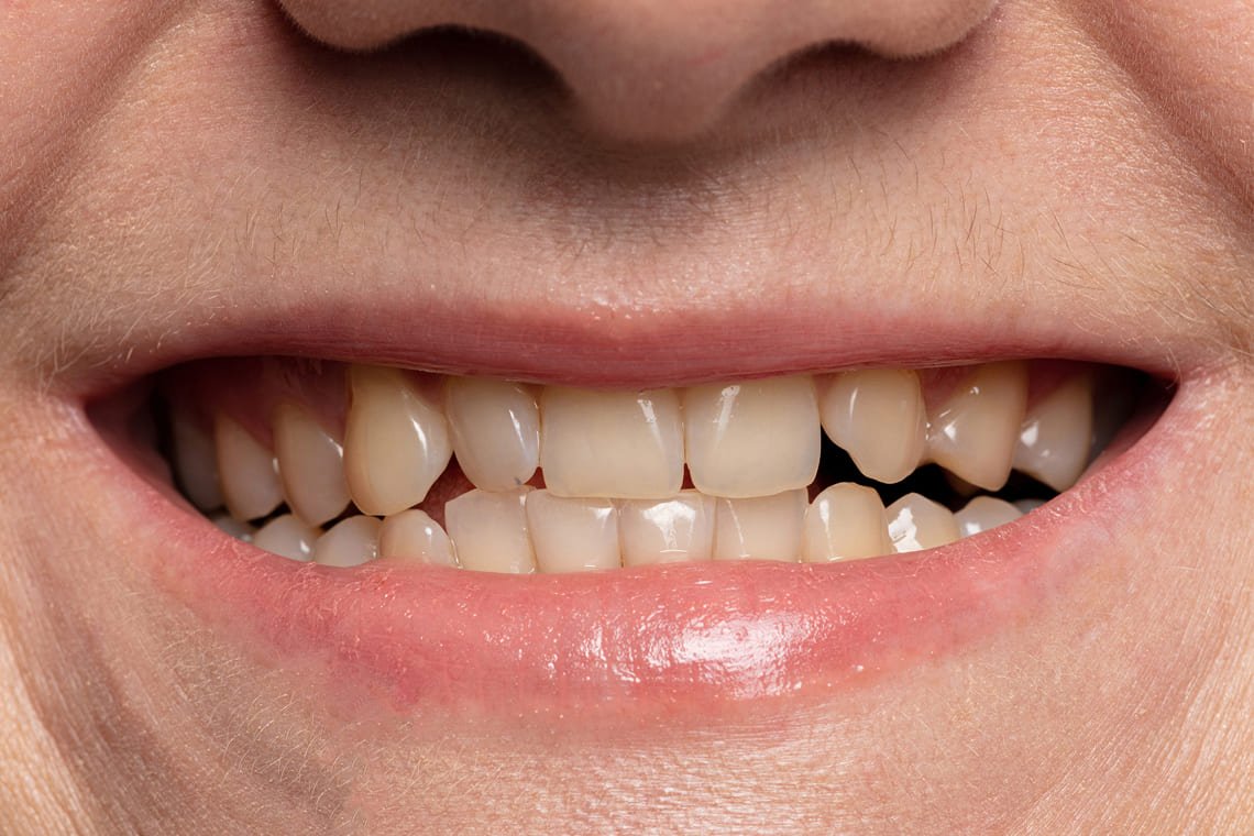 teeth-whitening-before-close-up.jpg
